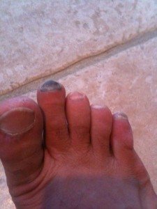 Black toe